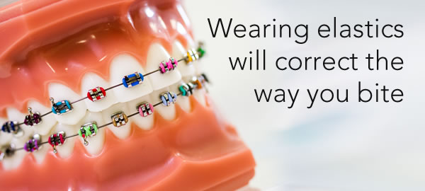 wearing elastics during your orthodontics treatment will help improve your bite