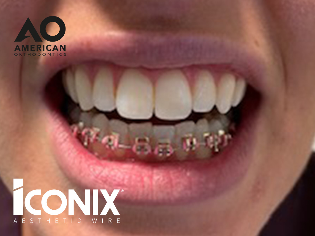 iconix braces teeth straightening