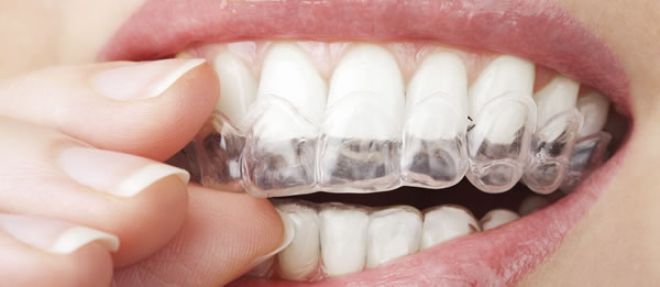 removable braces at refine dental