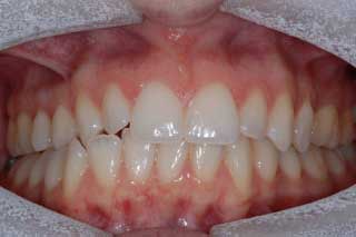 teeth whitening in  Derbyshire 