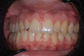  white teeth Derbyshire